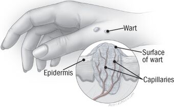 La estructura de la verruga en la mano. 
