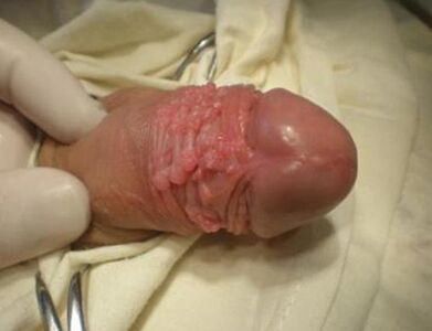 Papilloma en un miembro