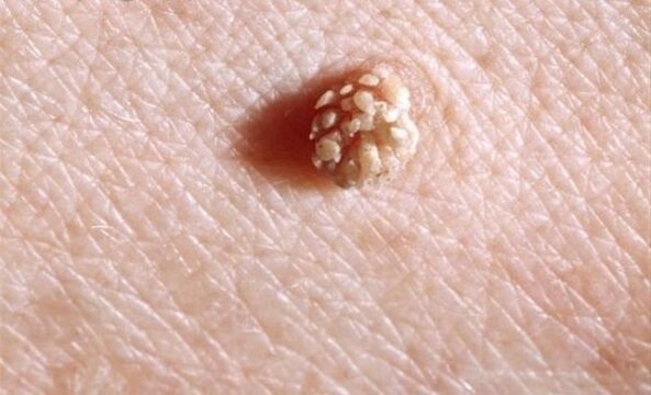 Papiloma en el cuerpo humano