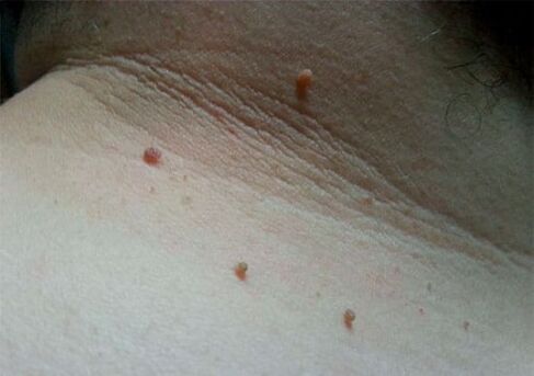 Papilomas en el cuello