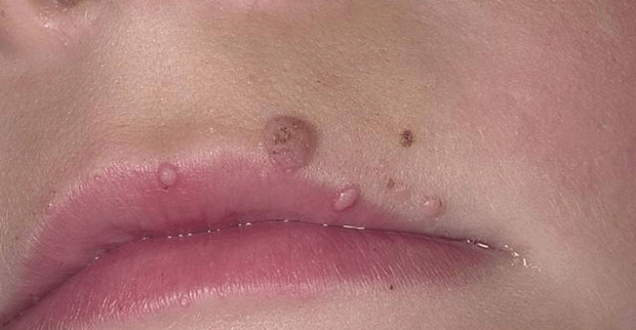 Papilomas en los labios