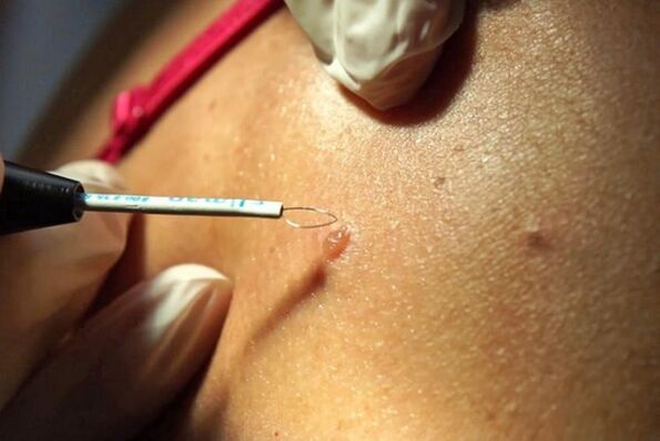 eliminación de verrugas en el cuerpo
